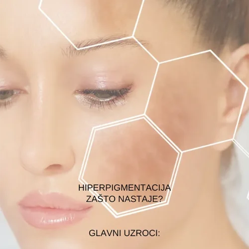 LaBellezza-Uklanjanje-hiperpigmentacije05